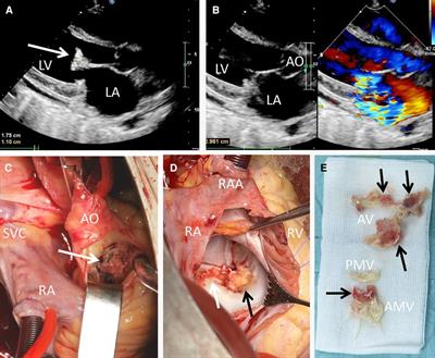 First case report of Candida guilliermondii native left-sided valve endocarditis